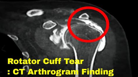 supraspinatus tear orthopedic test|incomplete full thickness tear supraspinatus.